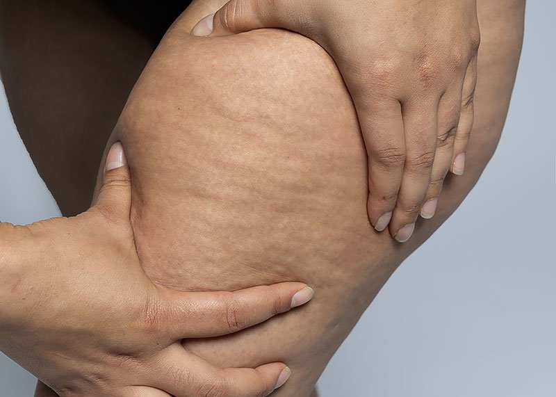 Lipedema