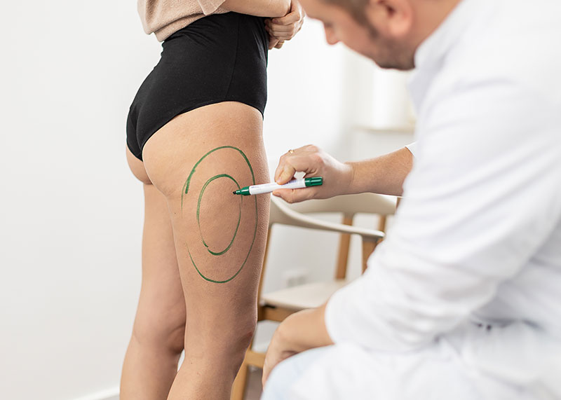 Anzeichnung-Liposuktion