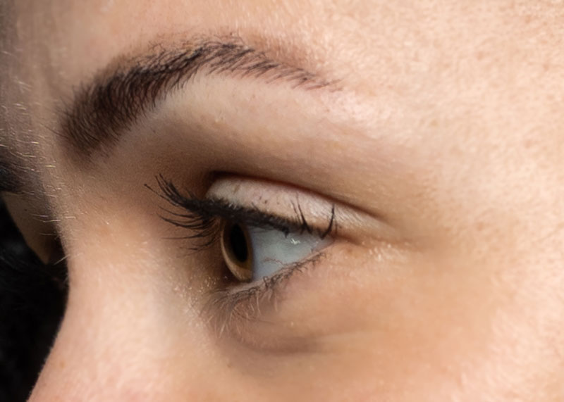 brow-lift